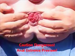 Analdehner asshole extrem anal gape men